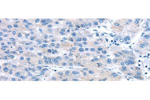 Immunohistochemistry of paraffin-embedded Human liver cancer using UCP2 Polyclonal Antibody at dilution of 1/20 (UCP2 Antikörper)