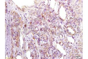 Formalin-fixed and paraffin embedded human cervical carcinoma labeled with Anti-IGFBP2 Polyclonal Antibody, Unconjugated (ABIN737781) at 1:200 followed by conjugation to the secondary antibody and DAB staining.
