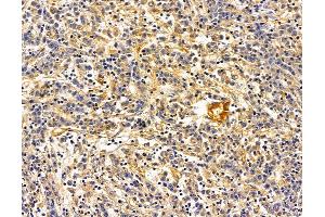 ABIN7095709 and ABIN7099771 at 1/100 staining human gastric cancer by IHC-P.