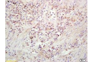 Formalin-fixed and paraffin embedded human lung carcinoma labeled with Rabbit Anti Kinesin Polyclonal Antibody, Unconjugated  at 1:200 followed by conjugation to the secondary antibody and DAB staining (Kinesin Antikörper  (AA 561-660))