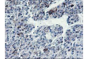 Immunohistochemical staining of paraffin-embedded Carcinoma of Human liver tissue using anti-PVRL1 mouse monoclonal antibody. (PVRL1 Antikörper)