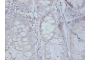 Immunohistochemistry of paraffin-embedded human colon cancer using ABIN7142508 at dilution of 1: 50 (RPS19 Antikörper  (AA 1-145))