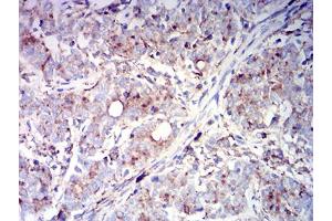 Immunohistochemical analysis of paraffin-embedded cervical cancer tissues using CD63 mouse mAb with DAB staining.