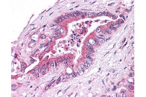 Anti-GPER1 / GPR30 antibody IHC of human Pancreas, Carcinoma.