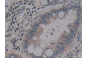 Detection of MMP14 in Human Colorectal cancer Tissue using Polyclonal Antibody to Matrix Metalloproteinase 14 (MMP14) (MMP14 Antikörper  (AA 322-541))