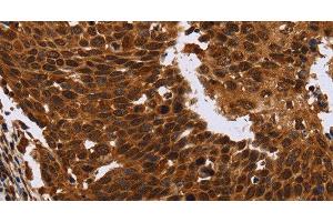 Immunohistochemistry of paraffin-embedded Human cervical cancer tissue using FANCF Polyclonal Antibody at dilution 1:60 (FANCF Antikörper)