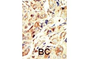 Formalin-fixed and paraffin-embedded human cancer tissue reacted with the primary antibody, which was peroxidase-conjugated to the secondary antibody, followed by DAB staining. (IGF1R Antikörper  (N-Term))