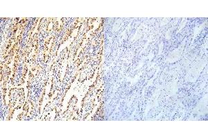 Immunohistochemical analysis of paraffin- embedded human lung carcinoma tissue using LKB1 (Ab-334) antibody (E022045). (LKB1 Antikörper)