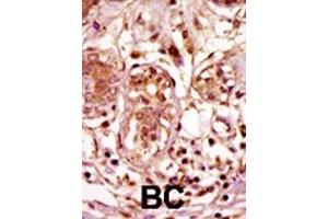 Formalin-fixed and paraffin-embedded human cancer tissue reacted with the primary antibody, which was peroxidase-conjugated to the secondary antibody, followed by AEC staining. (BUB1 Antikörper  (C-Term))