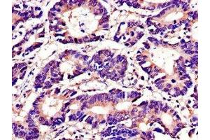 Immunohistochemistry of paraffin-embedded human colon cancer using ABIN7173671 at dilution of 1:100 (TUBA4A Antikörper  (AA 20-183))
