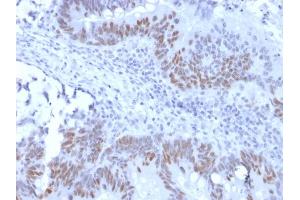 Formalin-fixed, paraffin-embedded human Colon Carcinoma stained with Retinoblastoma Recombinant Rabbit Monoclonal Antibody (RB1/2313R). (Rekombinanter Retinoblastoma 1 Antikörper)