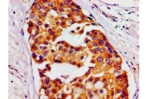Immunohistochemistry of paraffin-embedded human breast cancer using ABIN7155948 at dilution of 1:100 (HMMR Antikörper  (AA 478-653))