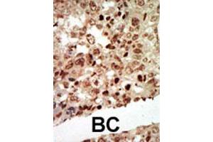 Formalin-fixed and paraffin-embedded human cancer tissue reacted with MAPK11 polyclonal antibody  , which was peroxidase-conjugated to the secondary antibody, followed by AEC staining. (MAPK11 Antikörper  (Internal Region))