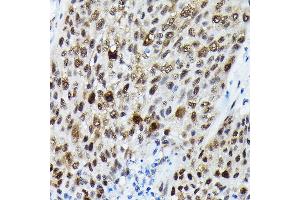 Immunohistochemistry of paraffin-embedded human lung cancer using Phospho-FOXO3A-S425 Rabbit pAb (ABIN7267246) at dilution of 1:250 (40x lens).