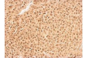 IHC-P Image RPL11 antibody detects RPL11 protein at cytosol and nucleus on HeLa xenograft by immunohistochemical analysis. (RPL11 Antikörper)