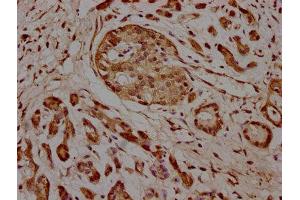 IHC image of ABIN7157636 diluted at 1:100 and staining in paraffin-embedded human pancreatic cancer performed on a Leica BondTM system. (KIF25 Antikörper  (AA 1-262))