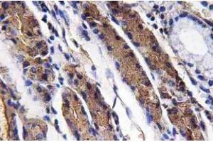 Immunohistochemistry analysis of Pepsin A Antibody in paraffin-embedded human lung carcinoma tissue. (Pepsin Antikörper)
