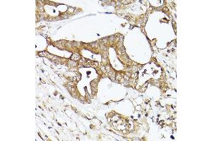 Immunohistochemistry of paraffin-embedded human colon carcinoma using  Rabbit pAb (ABIN7265370) at dilution of 1:50 (40x lens). (Acetyl-CoA Carboxylase alpha Antikörper)