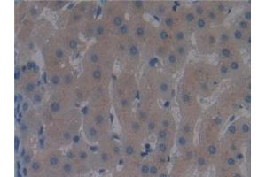 Detection of DBP in Human Liver cancer Tissue using Polyclonal Antibody to Vitamin D Binding Protein (DBP) (Vitamin D-Binding Protein Antikörper  (AA 395-474))
