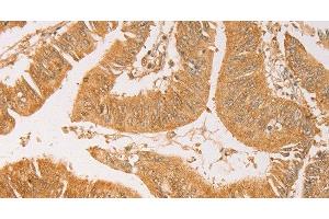 Immunohistochemistry of paraffin-embedded Human colon cancer using AK2 Polyclonal Antibody at dilution of 1:40