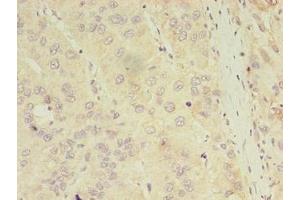 Immunohistochemistry of paraffin-embedded human liver cancer using ABIN7144179 at dilution of 1:100 (ASB11 Antikörper  (AA 41-315))