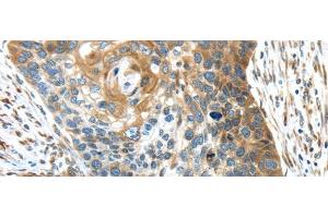 Immunohistochemistry of paraffin-embedded Human esophagus cancer using TMED4 Polyclonal Antibody at dilution of 1/45 (TMED4 Antikörper)