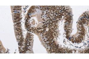 Immunohistochemistry of paraffin-embedded Human colon cancer tissue using CMTM2 Polyclonal Antibody at dilution 1:60 (CMTM2 Antikörper)