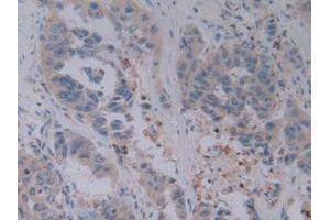 IHC-P analysis of Human Breast cancer Tissue, with DAB staining. (GZMB Antikörper  (AA 21-247))