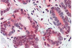 Human Breast (formalin-fixed, paraffin-embedded) stained with ATF6 antibody ABIN351433 at 5 ug/ml followed by biotinylated goat anti-rabbit IgG secondary antibody ABIN481713, alkaline phosphatase-streptavidin and chromogen. (ATF6 Antikörper  (N-Term))