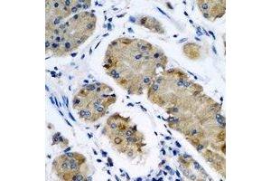Immunohistochemical analysis of OPA3 staining in human gastric cancer formalin fixed paraffin embedded tissue section.
