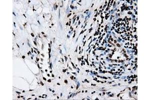 Immunohistochemical staining of paraffin-embedded Adenocarcinoma of colon tissue using anti-RPA2mouse monoclonal antibody. (RPA2 Antikörper)