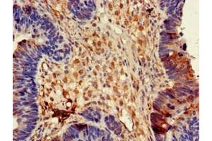 Immunohistochemistry of paraffin-embedded human ovarian cancer using ABIN7149934 at dilution of 1:100 (DPYSL4 Antikörper  (AA 280-560))
