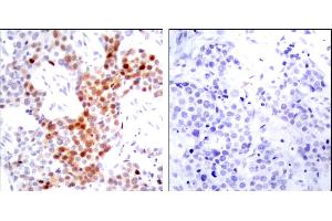 Immunohistochemical analysis of paraffin-embedded breast carcinoma. (ATF2 Antikörper  (pThr51, pThr69))