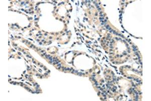 The image on the left is immunohistochemistry of paraffin-embedded Human thyroid cancer tissue using ABIN7193032(VSIG10 Antibody) at dilution 1/45, on the right is treated with synthetic peptide. (VSIG1 Antikörper)