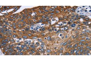 Immunohistochemistry of paraffin-embedded Human cervical cancer tissue using FCGR3A Polyclonal Antibody at dilution 1:40 (FCGR3A Antikörper)