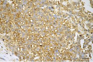 Immunohistochemistry was performed on paraffin-embedded human breast carcinoma using GAPDH antibody (ABIN7798768), 1:500). (Rekombinanter GAPDH Antikörper)
