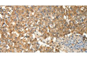 Immunohistochemistry of paraffin-embedded Human breast cancer using PRDX3 Polyclonal Antibody at dilution of 1:50 (Peroxiredoxin 3 Antikörper)