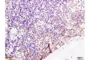 Formalin-fixed and paraffin embedded human endometrium carcinoma tissue labeled with Anti-Cyclin G Polyclonal Antibody, Unconjugated (ABIN685837) at 1:200 followed by conjugation to the secondary antibody and DAB stainin (Cyclin G1 Antikörper  (AA 181-295))