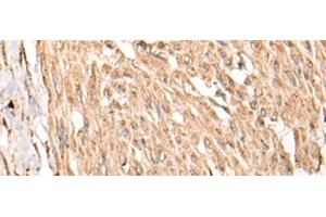 Immunohistochemistry of paraffin-embedded Human cervical cancer tissue using HSF4 Polyclonal Antibody at dilution of 1:55(x200) (HSF4 Antikörper)