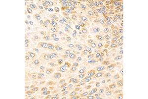 Immunohistochemistry analysis of paraffin-embedded human esophageal cancer using Torsin A (ABIN7075942) at dilution of 1: 800 (TOR1A Antikörper)