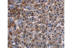 Immunohistochemistry of Human lung cancer using KCNK1 Polyclonal Antibody at dilution of 1:50 (KCNK1 Antikörper)