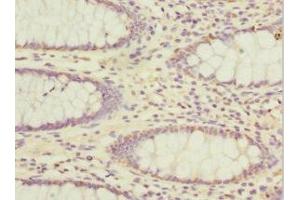 Immunohistochemistry of paraffin-embedded human colon cancer using ABIN7143282 at dilution of 1:100