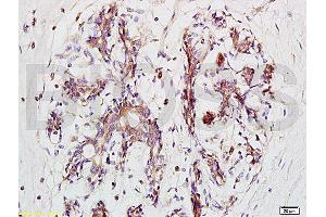 Formalin-fixed and paraffin embedded human breast carcinoma tissue labeled with Anti-BRMS-1 Polyclonal Antibody, Unconjugated (ABIN730933) at 1:200 followed by conjugation to the secondary antibody and DAB staining (BRMS1L Antikörper  (AA 151-246))