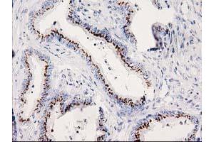 Immunohistochemical staining of paraffin-embedded Adenocarcinoma of Human colon tissue using anti-SOCS3 mouse monoclonal antibody. (SOCS3 Antikörper)