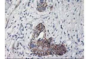 Immunohistochemical staining of paraffin-embedded Adenocarcinoma of Human breast tissue using anti-APBB3 mouse monoclonal antibody. (APBB3 Antikörper)