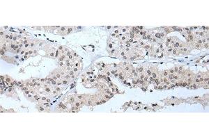 Immunohistochemistry of paraffin-embedded Human liver cancer tissue using TBX1 Polyclonal Antibody at dilution of 1:40(x200) (T-Box 1 Antikörper)