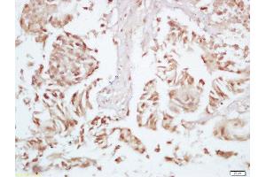 Formalin-fixed and paraffin embedded human colon carcinoma labeled with Rabbit Anti-P70 S6 Kinase beta 2 (Ser370) Polyclonal Antibody, Unconjugated 1:200 followed by conjugation to the secondary antibody and DAB staining (RPS6KB2 Antikörper  (pSer370))