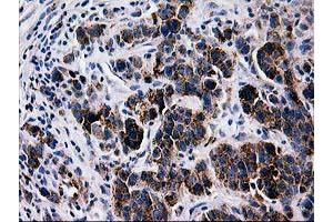Immunohistochemical staining of paraffin-embedded Carcinoma of Human lung tissue using anti-LGALS3BP mouse monoclonal antibody.