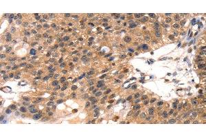 Immunohistochemistry of paraffin-embedded Human breast cancer using TLN1 Polyclonal Antibody at dilution of 1:35 (TLN1 Antikörper)