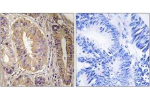 Immunohistochemistry analysis of paraffin-embedded human colon carcinoma tissue, using FAK (Ab-843) Antibody. (FAK Antikörper  (AA 809-858))